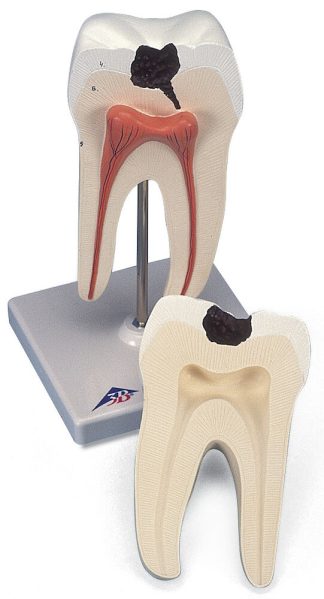 Tand med karies - modell