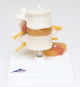 Ryggkotor med diskbråck - modell